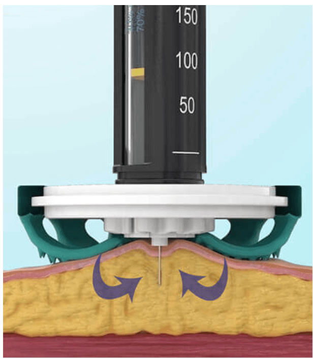 Diabeteshjalp insulin hjälpmedel TickleFLEX novo rapid Injection reducering – Gör sticket Enklare och Bekvämare