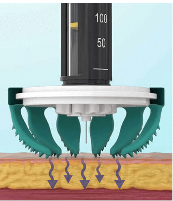 Diabeteshjalp insulin hjälpmedel TickleFLEX novo rapid Injection reducering – Gör sticket Enklare och Bekvämare