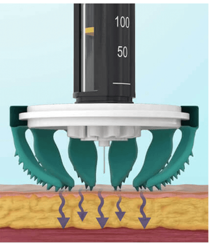 Diabeteshjalp insulin hjälpmedel TickleFLEX novo rapid Injection reducering – Gör sticket Enklare och Bekvämare